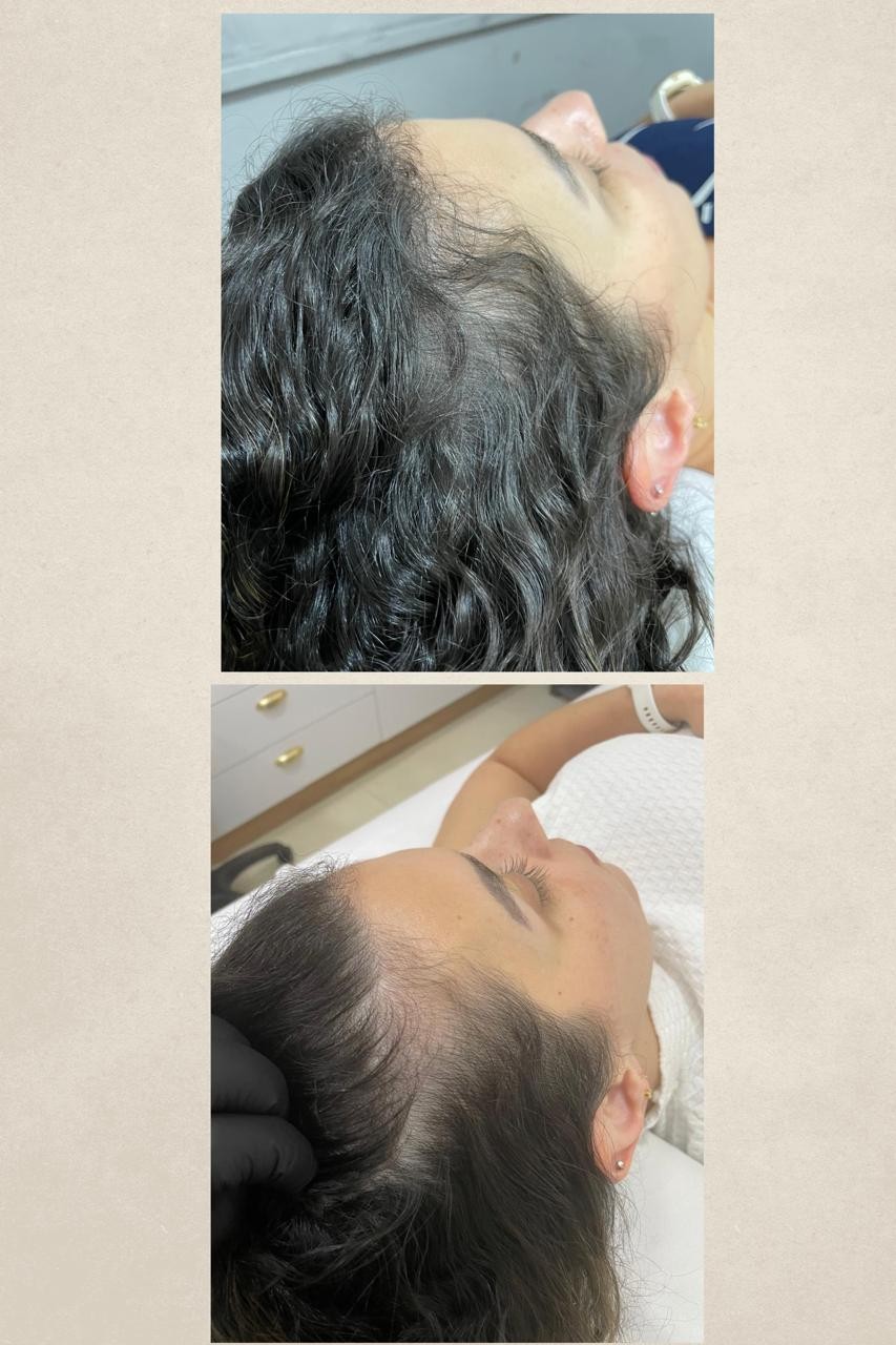 Antes e depois do couro cabeludo na linha de implantação