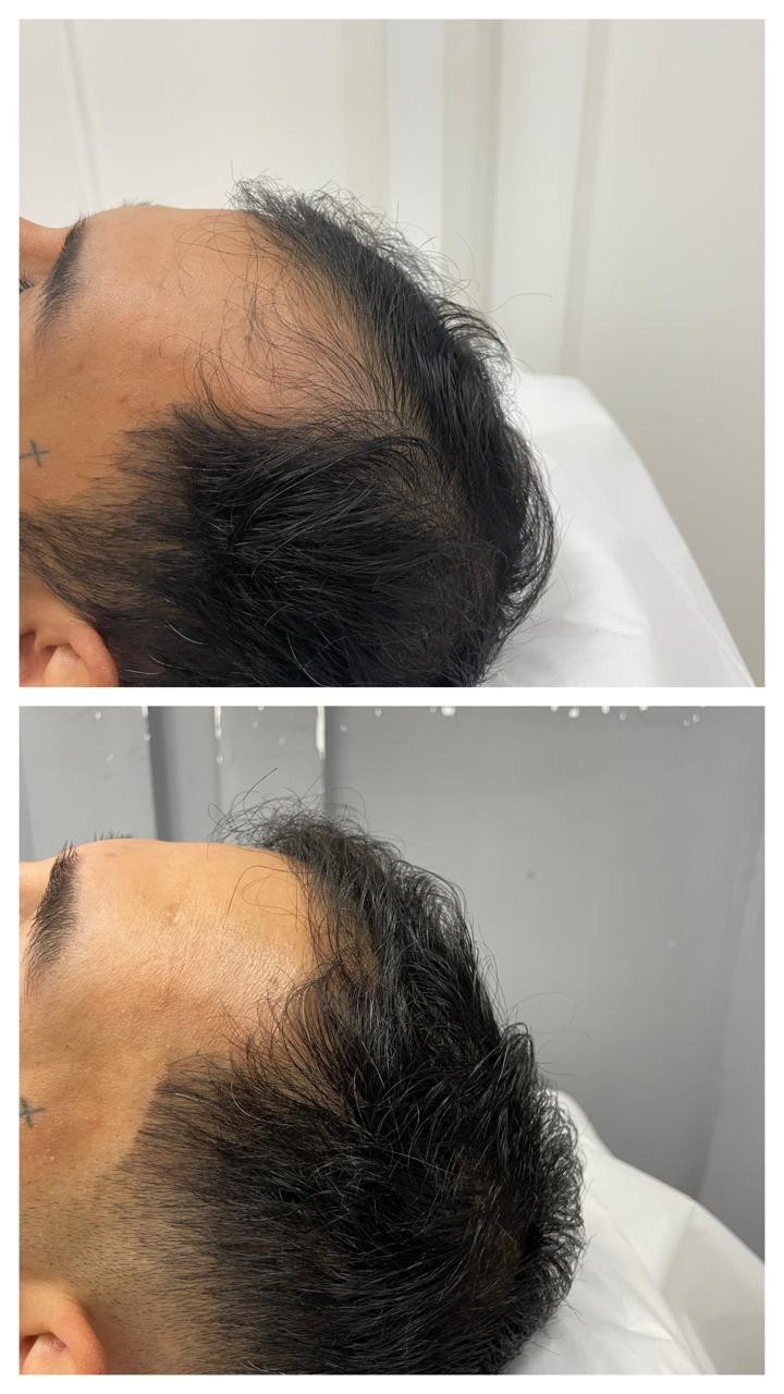 Antes e depois da região das entradas temporais