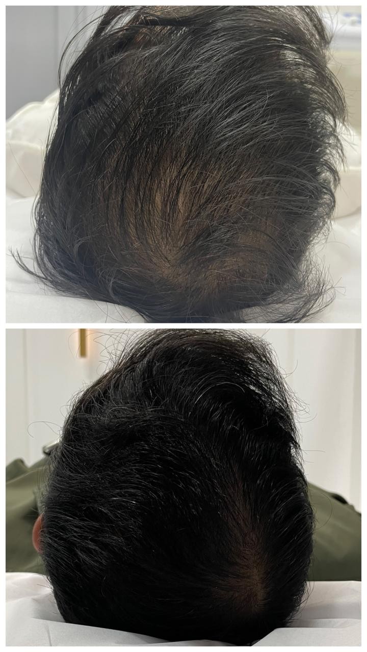 Antes e depois do topo da cabeça